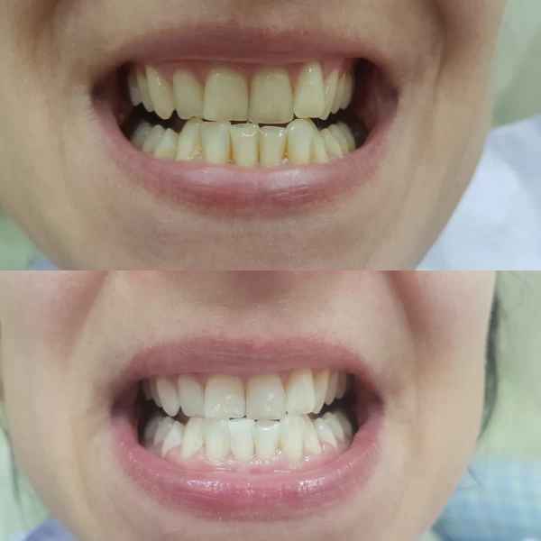 Izbeljenje zuba - beljenje zuba